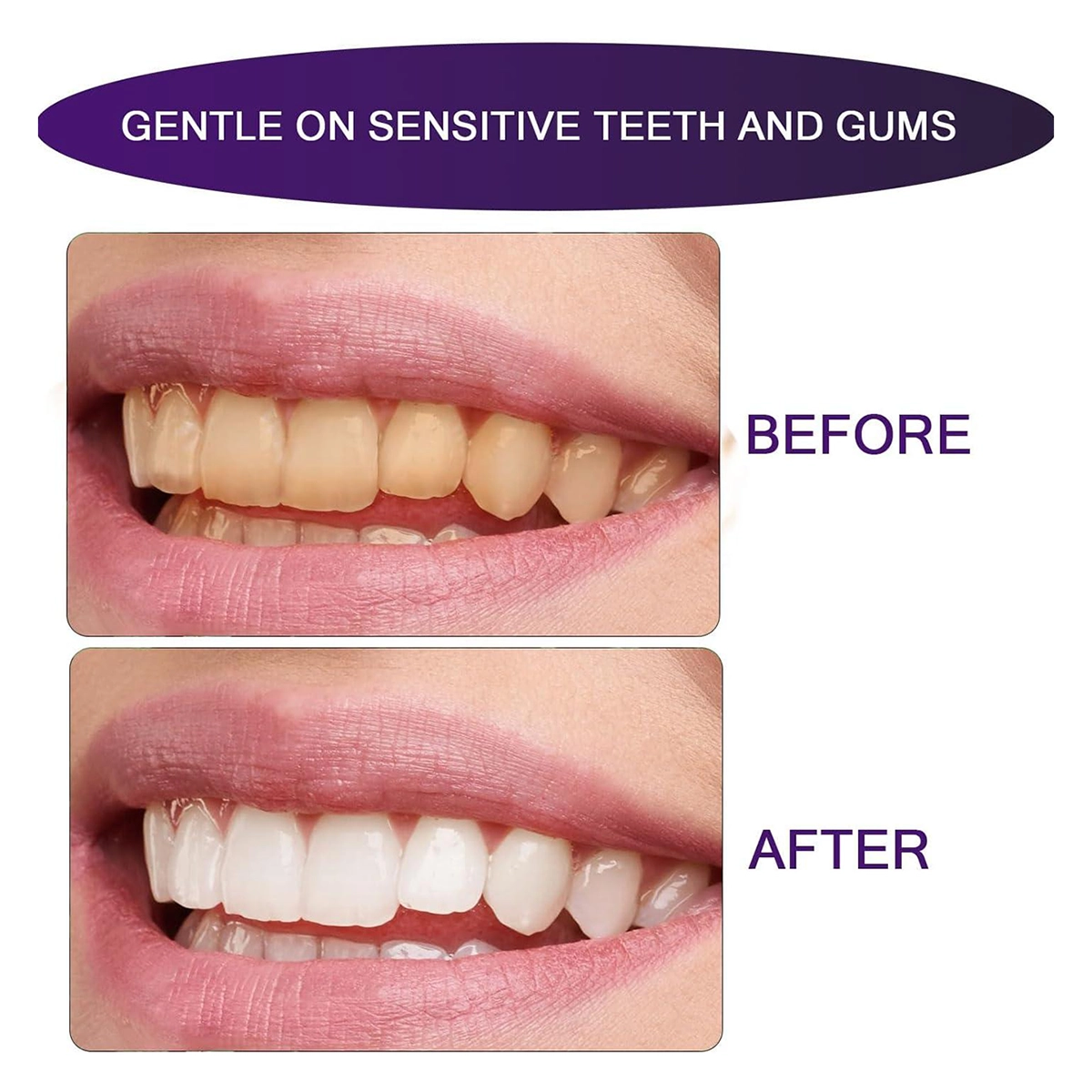 سفید کننده دندان Smilekit مدل V34